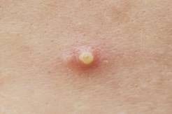 (咪莫特乳膏对长出来的疣有用吗)探秘咪莫特乳膏：功效、价格、真假对比及用户口碑综合评测